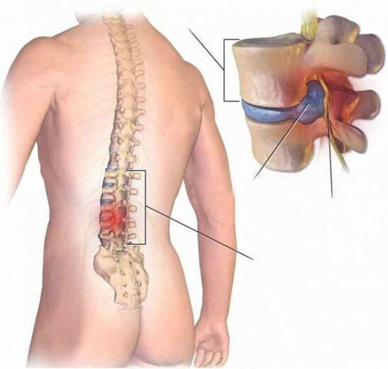 Hernia intervertebral